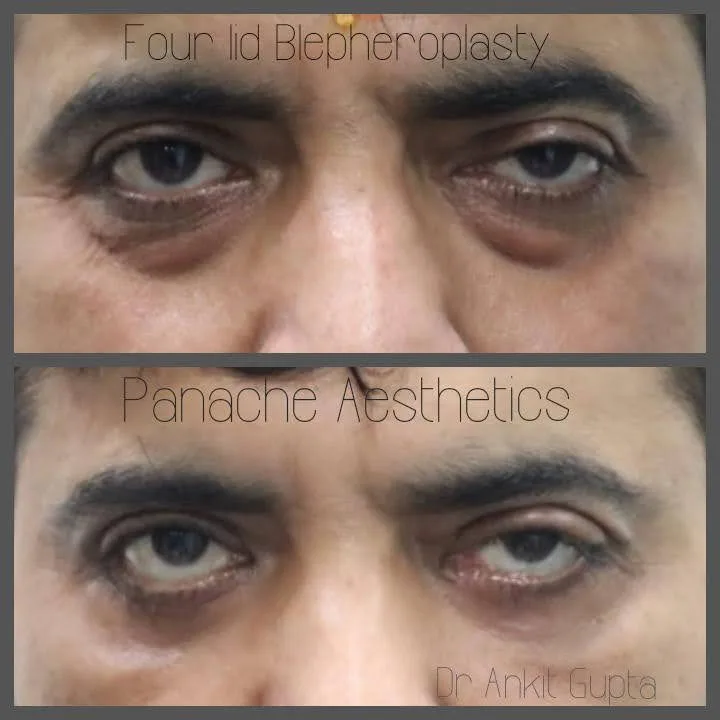 Blepharoplasty recovery before and after — natural scarless healing — Delhi