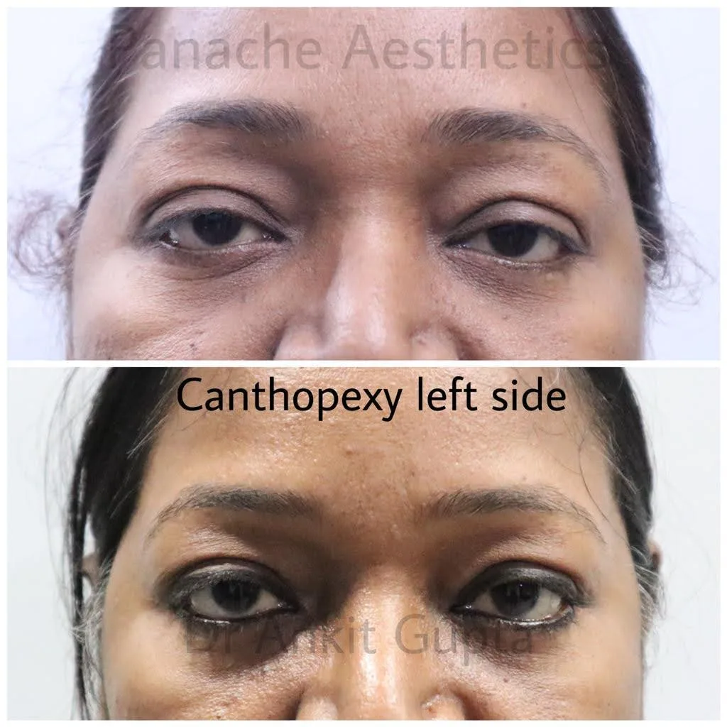 Upper eyelid surgery before and after result — Dr. Ankit Gupta