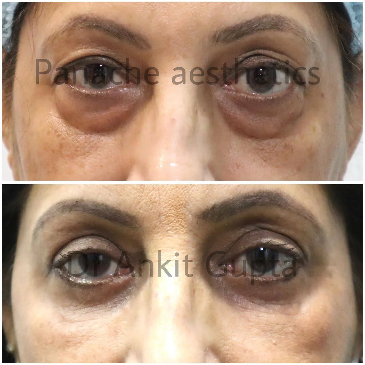 Droopy eyelid surgery before and after — upper lid lift — Dr. Ankit Gupta, Panache Aesthetics Delhi