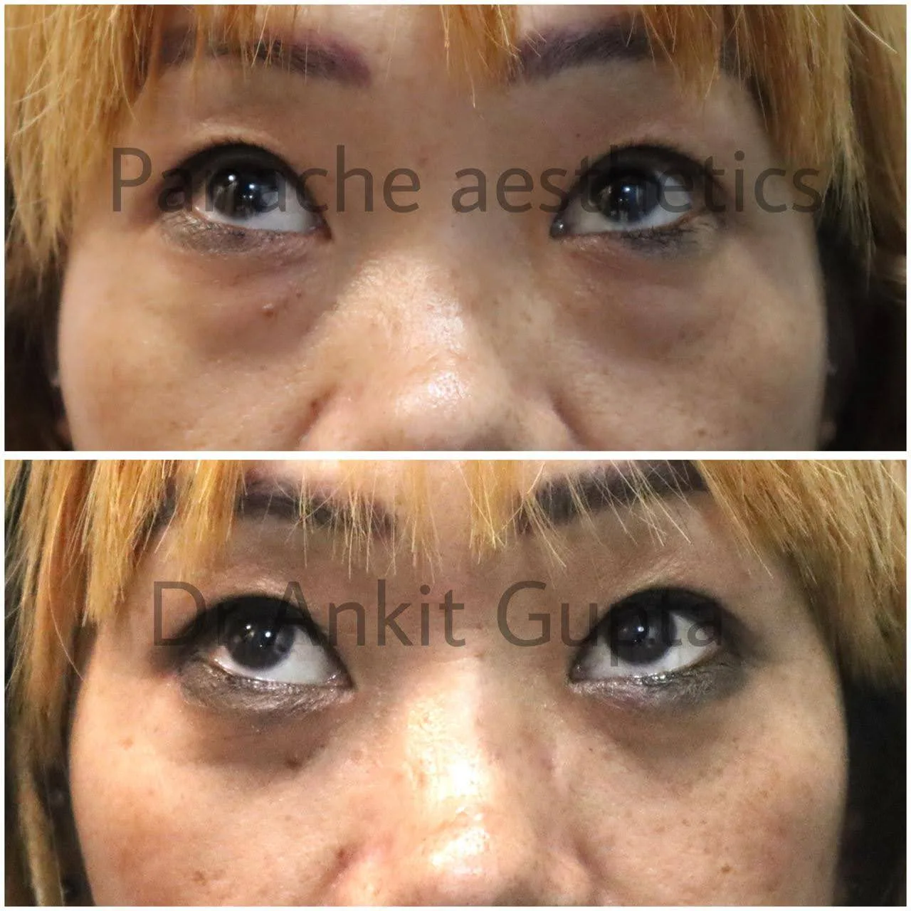 Sagging upper eyelid before and after surgery result — younger eyes — Delhi
