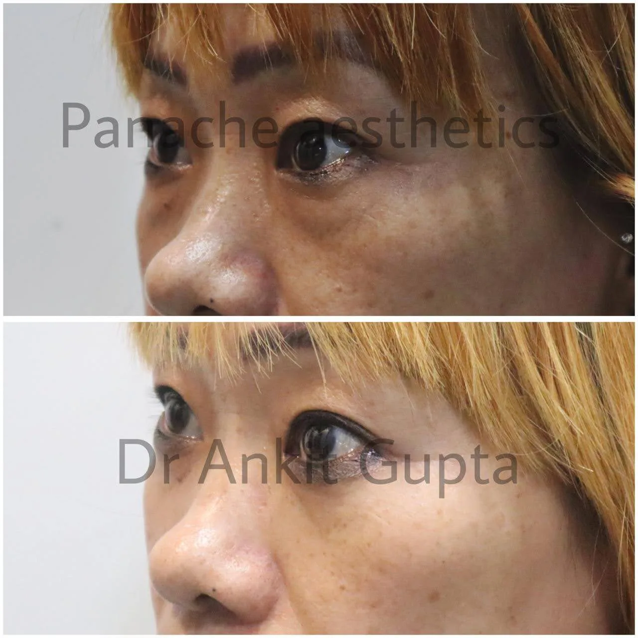 Droopy eyelid blepharoplasty before and after — Dr. Ankit Gupta