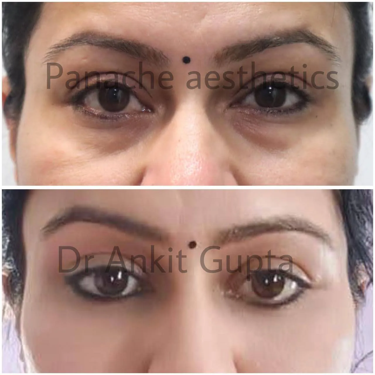 Eye bag surgery before and after — lower eyelid blepharoplasty — Dr. Ankit Gupta, Panache Aesthetics Delhi