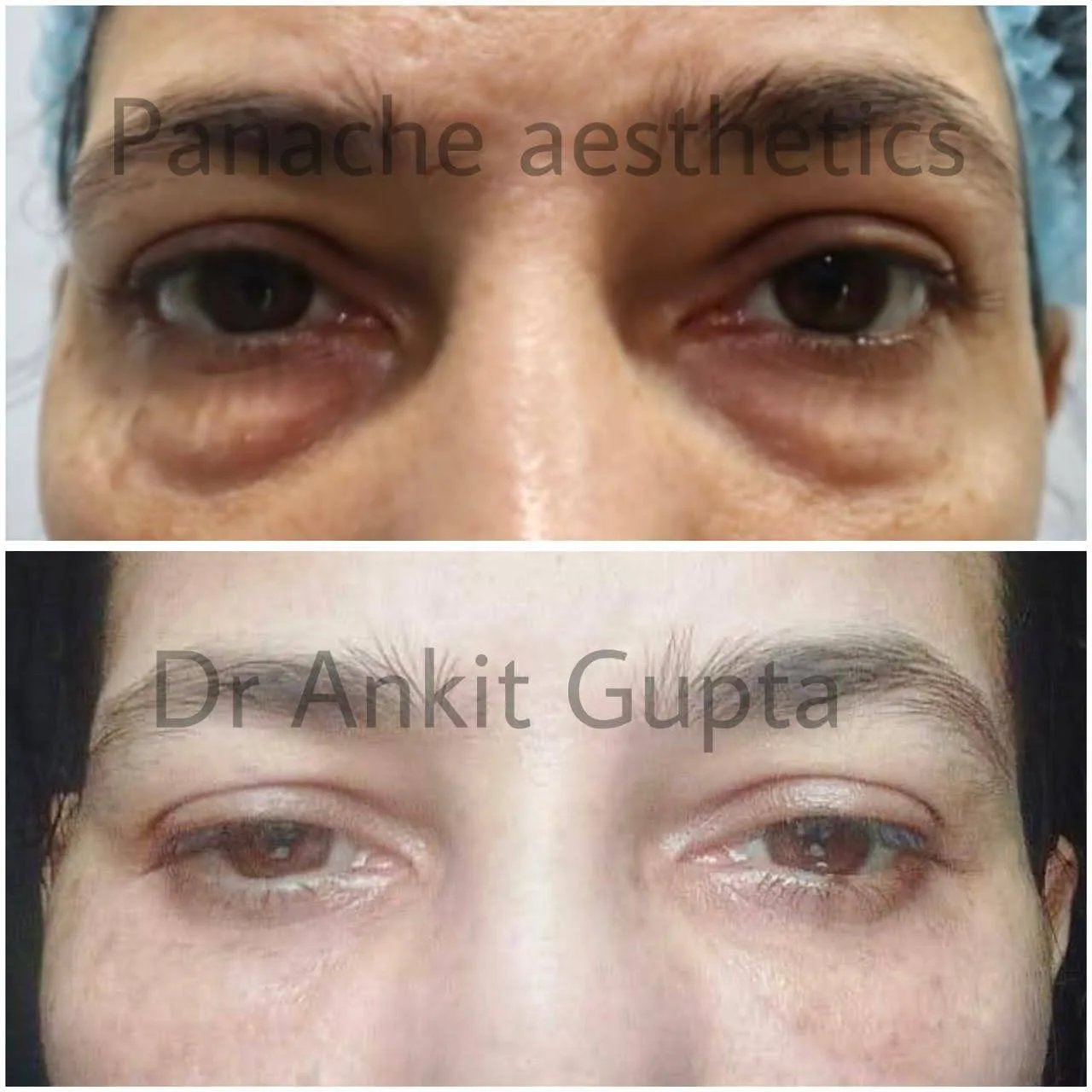 Lower eyelid surgery before and after — puffy under-eye correction — Delhi