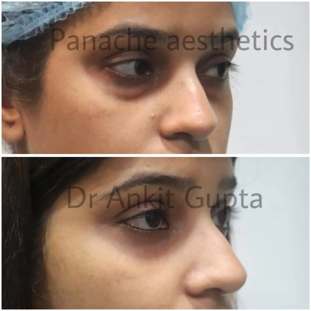 Under-eye bag blepharoplasty before and after result — Dr. Ankit Gupta