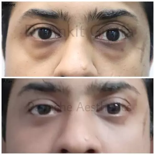 Blepharoplasty result — Combined upper & lower blepharoplasty