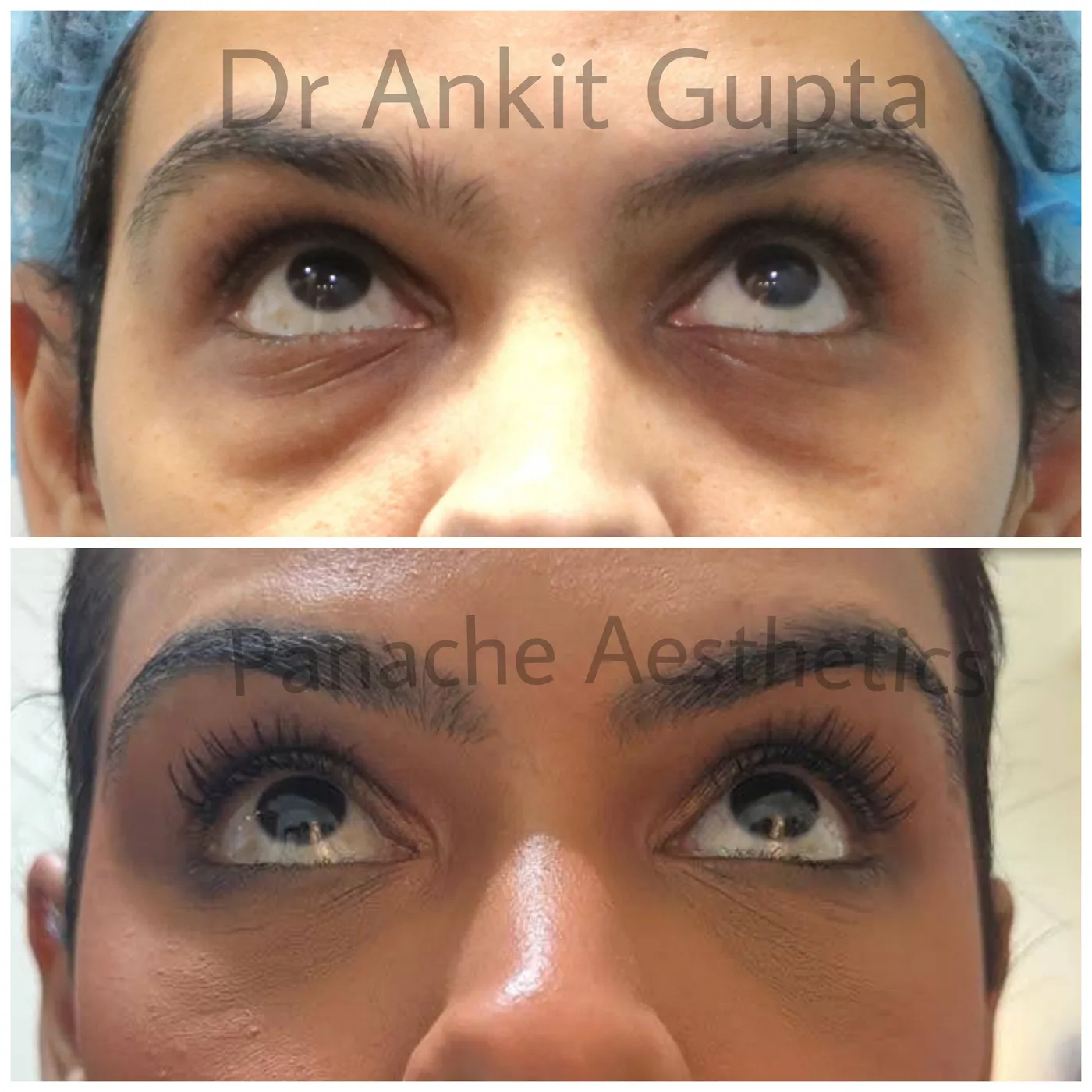 Blepharoplasty result — Panache Aesthetics, Delhi