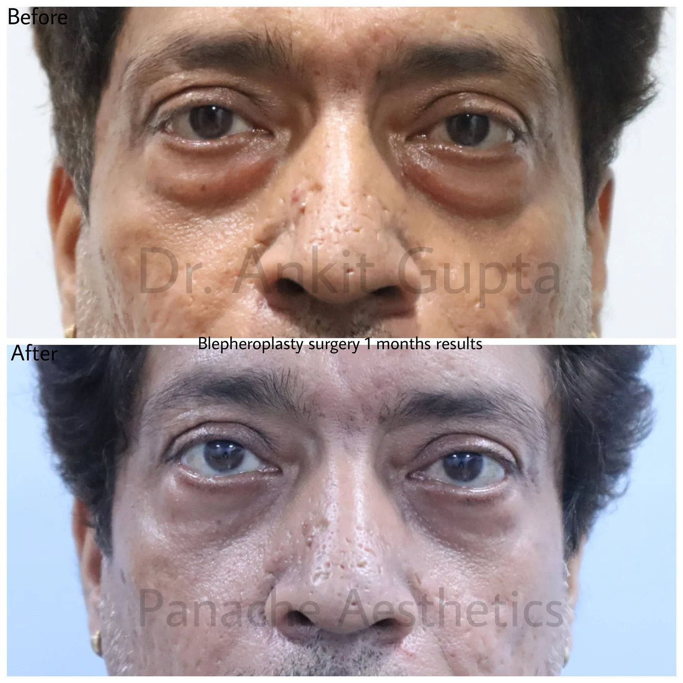 Male lower eyelid blepharoplasty before and after in Delhi — severe under-eye bag removal, one-month result by Dr. Ankit Gupta