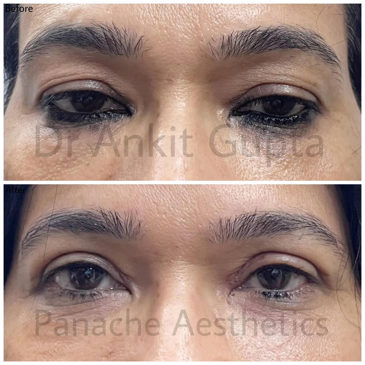 Upper eyelid blepharoplasty before and after in Delhi — hooded upper lid lift for brighter, more open eyes by Dr. Ankit Gupta, Panache Aesthetics