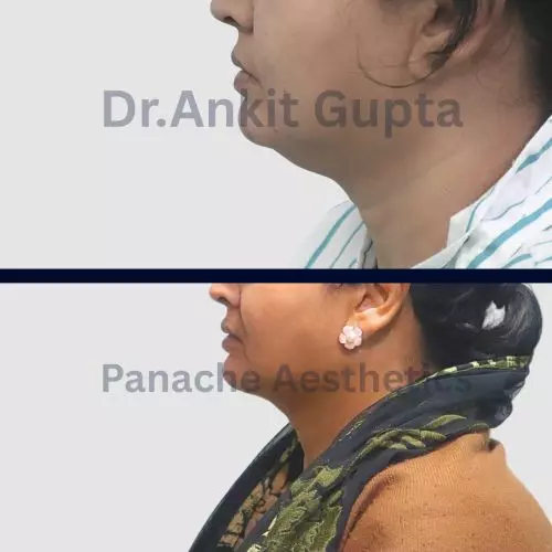 Double chin removal before and after — sharper jawline — Dr. Ankit Gupta