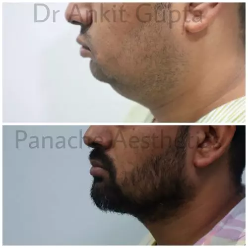 Submental fat removal and chin definition before and after result — Delhi