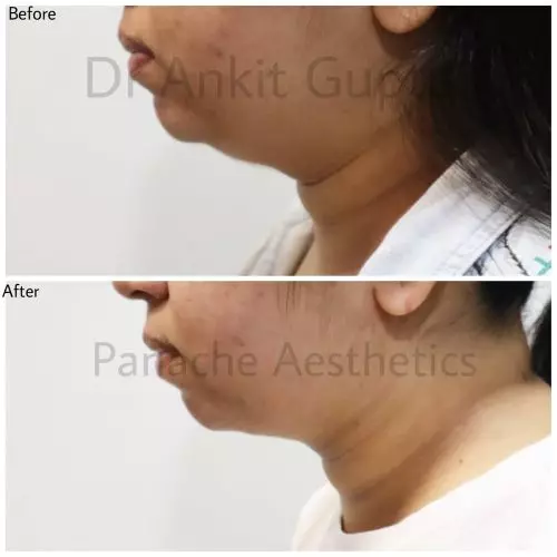 Double chin liposuction before and after — defined jawline — Dr. Ankit Gupta, Panache Aesthetics Delhi