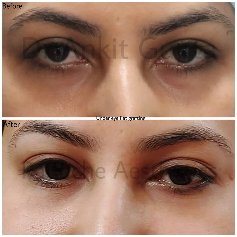 Under-eye dark circle treatment before and after — fat grafting — Dr. Ankit Gupta, Panache Aesthetics Delhi