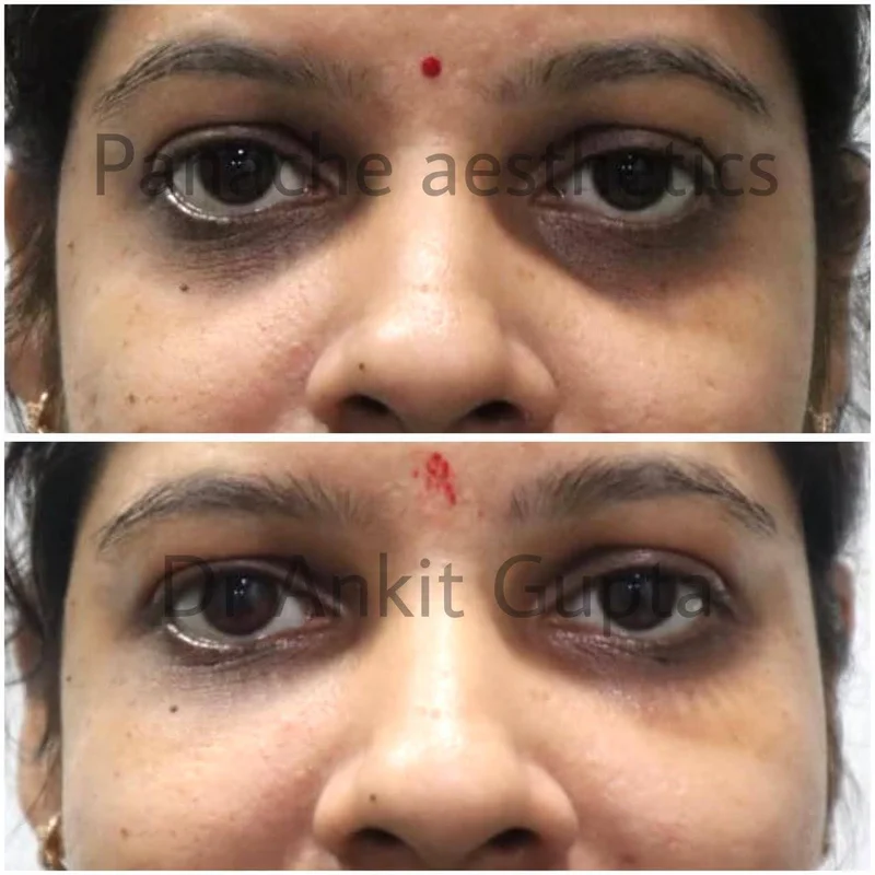 Dark circle and hollow under-eye correction before and after result — Delhi