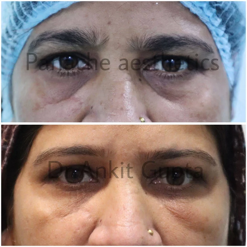 Tear trough and dark circle treatment before and after — Dr. Ankit Gupta
