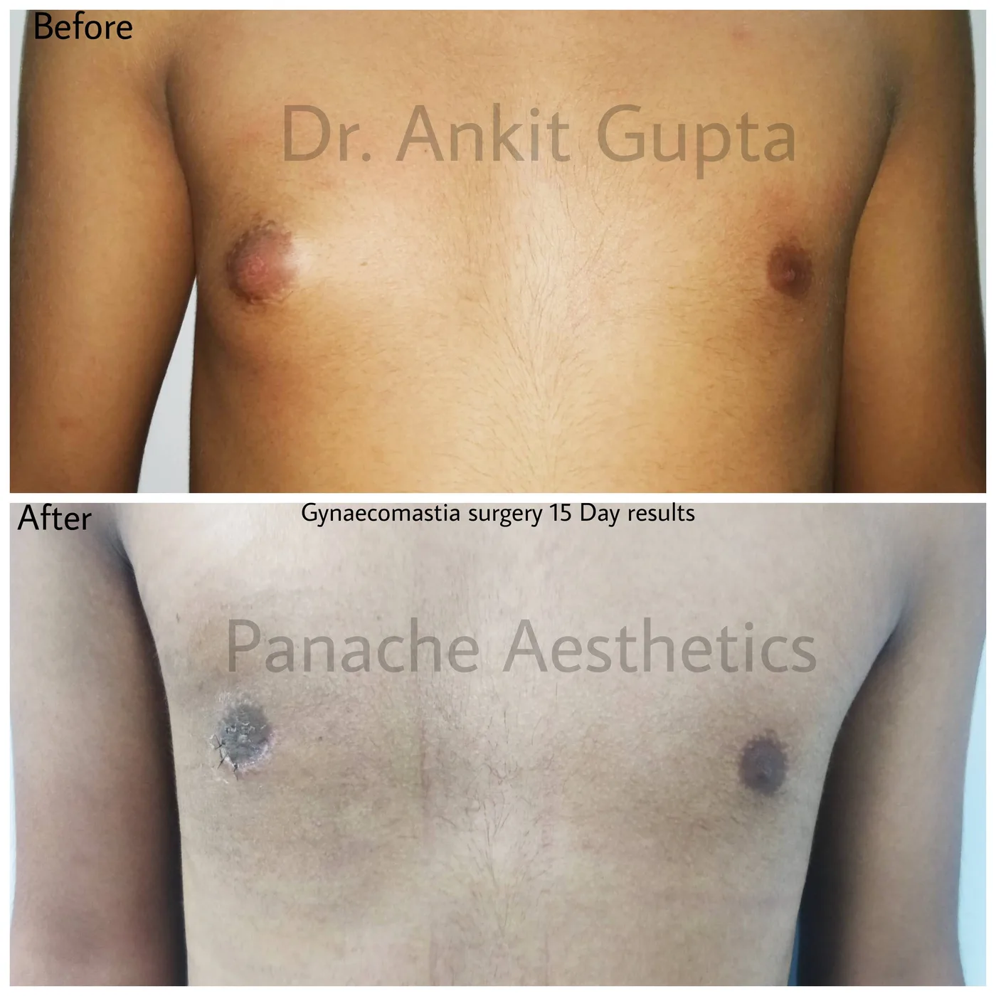 Grade 1 gynecomastia (puffy nipples) before and after in Delhi — gland removal for a flat chest, Dr. Ankit Gupta