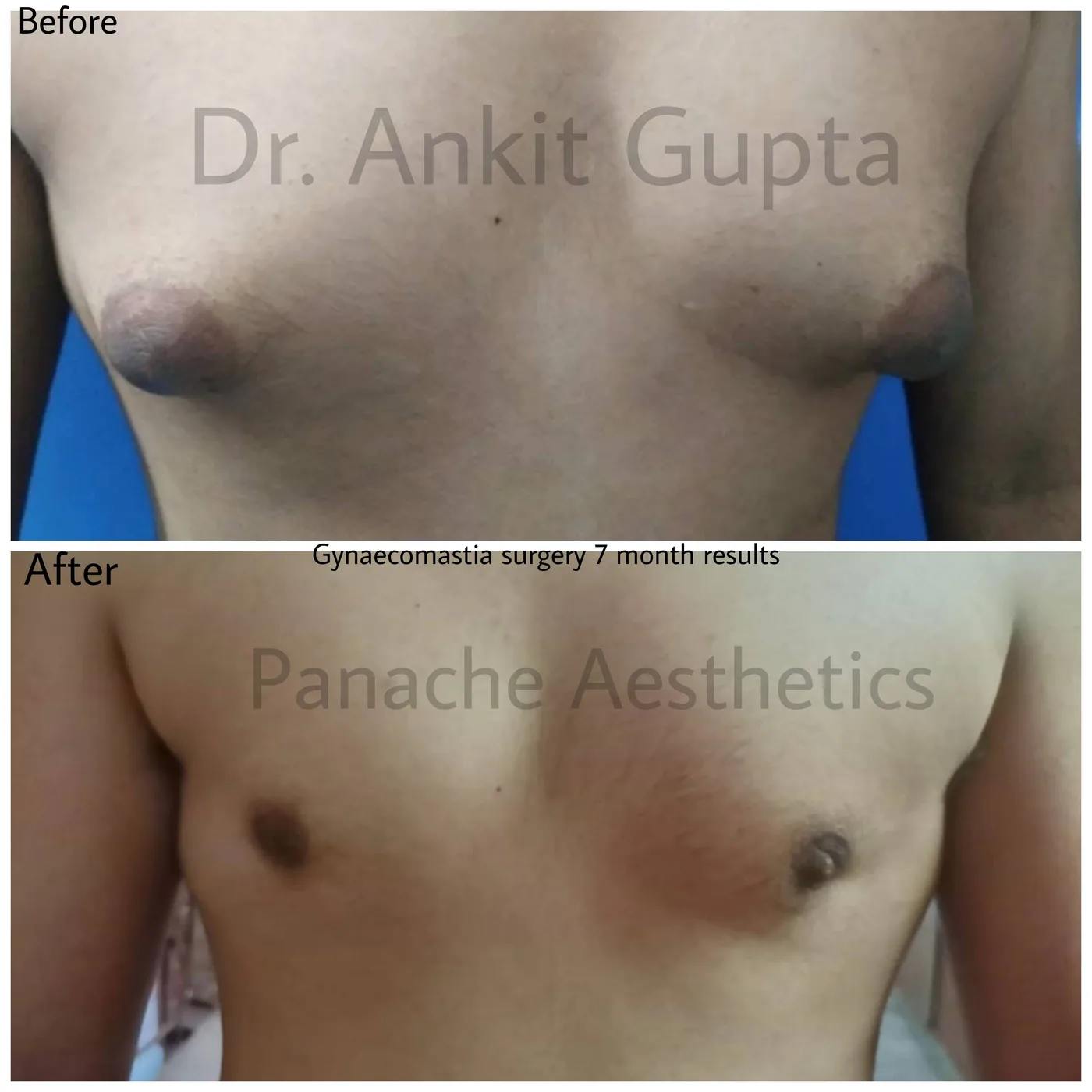 Grade 3 gynecomastia surgery before and after in Delhi — severe male breast correction with gland excision and liposuction, Dr. Ankit Gupta, Panache Aesthetics