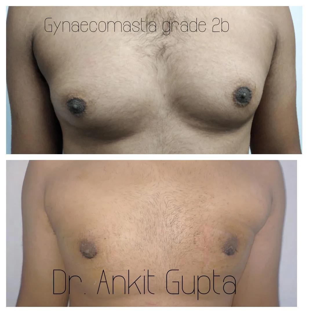 Gynecomastia surgery before and after — flat masculine chest — Dr. Ankit Gupta, Panache Aesthetics Delhi