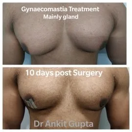 Gland excision and liposuction gynecomastia before and after result — Delhi
