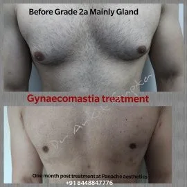 VASER gynecomastia surgery before and after — sculpted chest — Dr. Ankit Gupta