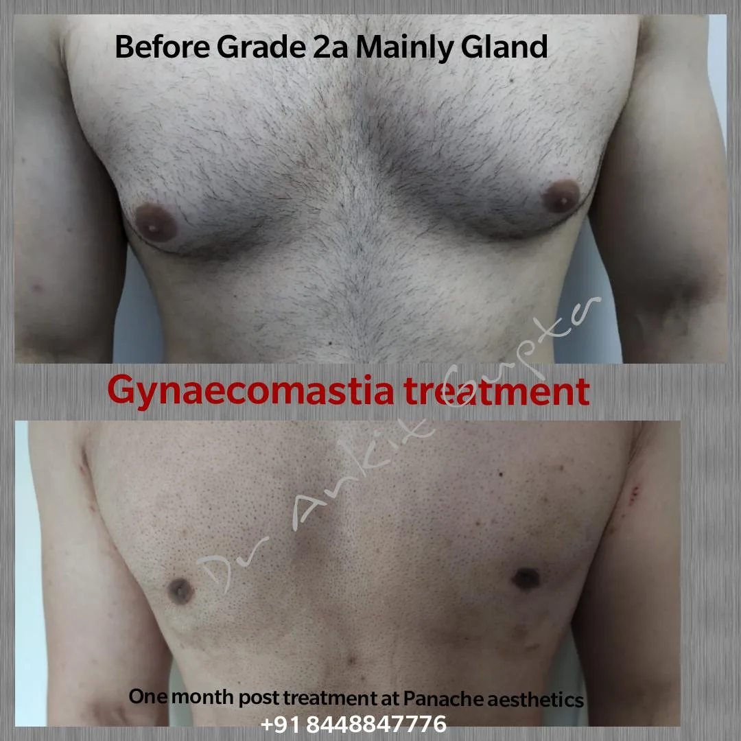 Grade 2 gynecomastia surgery before and after — Dr. Ankit Gupta, Panache Aesthetics Delhi