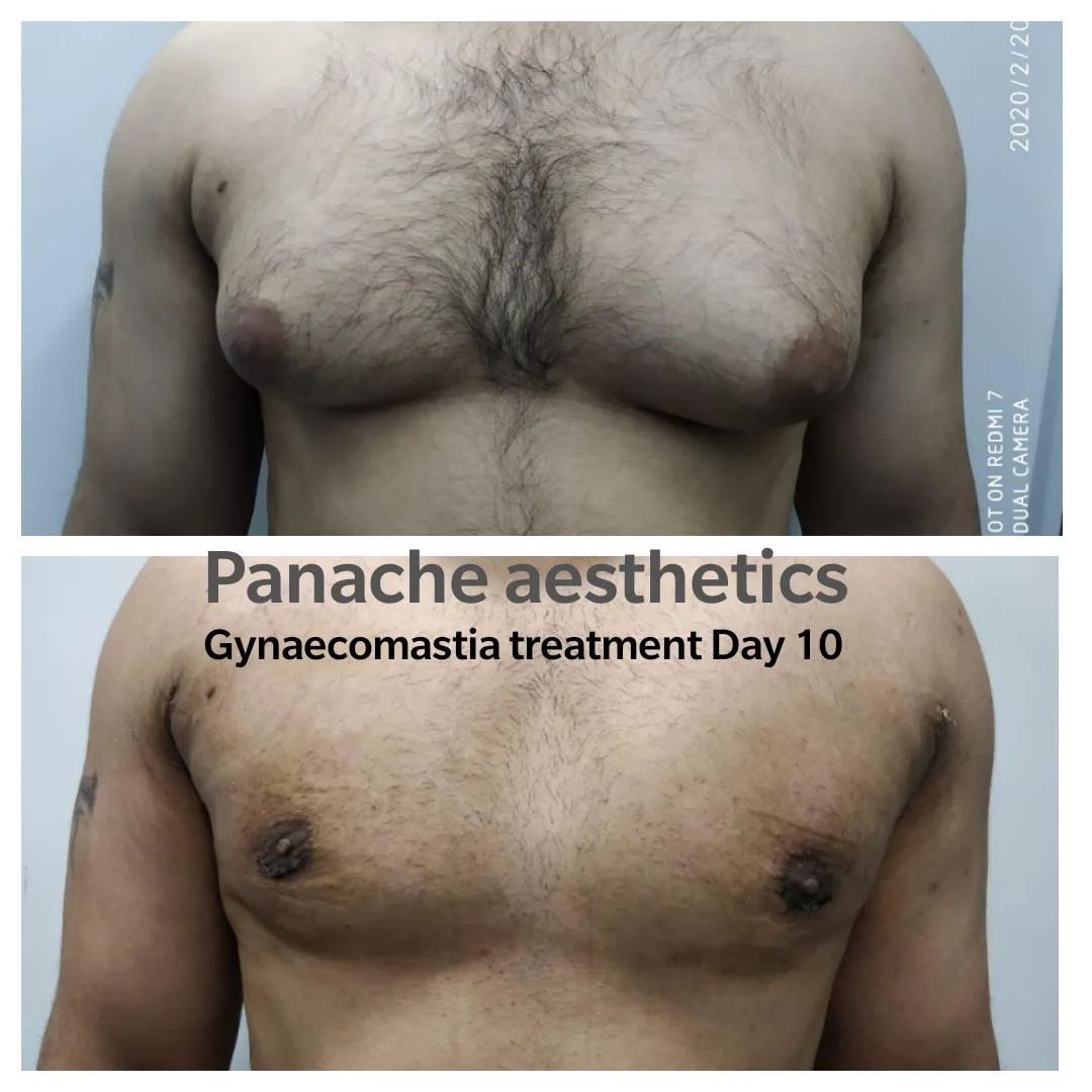 Gynecomastia gland excision before and after result — flat chest — Delhi