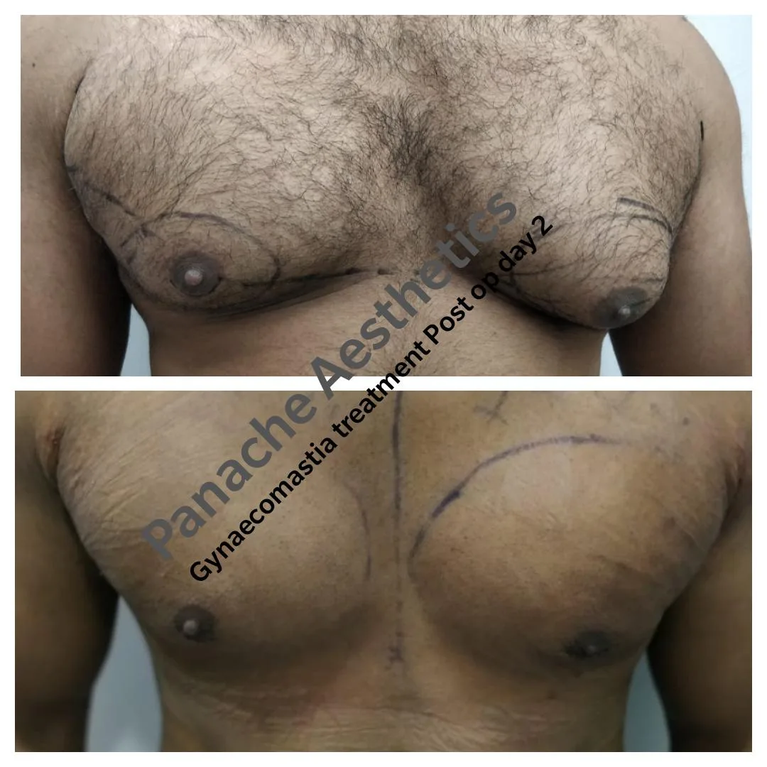 Higher grade gynecomastia surgery before and after — male chest contouring — Dr. Ankit Gupta
