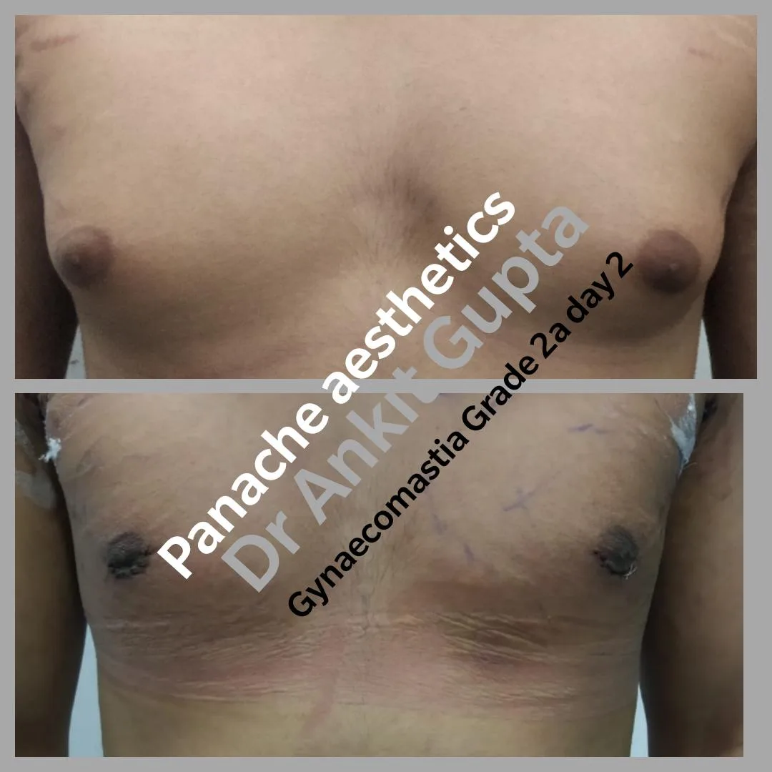 Man boobs treatment before and after — gynecomastia surgery — Dr. Ankit Gupta, Panache Aesthetics Delhi