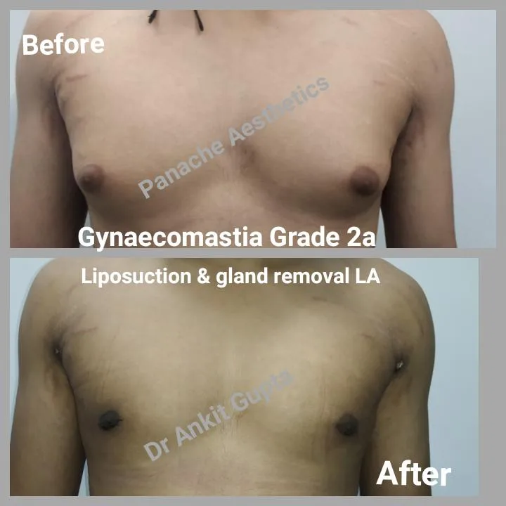 Male chest fat and gland removal before and after result — Delhi