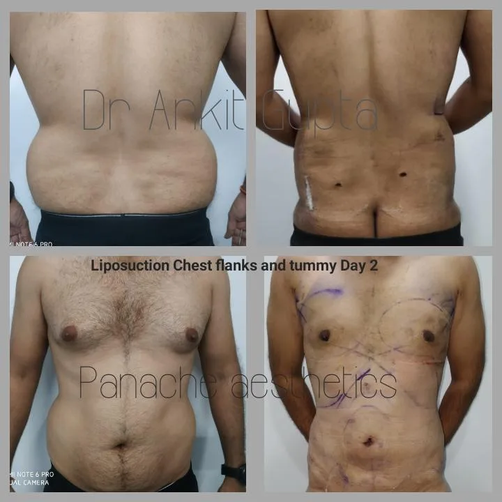 Gynecomastia surgery before and after — masculine flat chest — Dr. Ankit Gupta