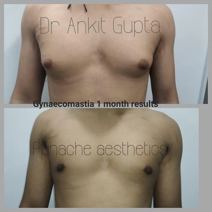 Gynecomastia surgery by plastic surgeon before and after — Dr. Ankit Gupta, Panache Aesthetics Delhi