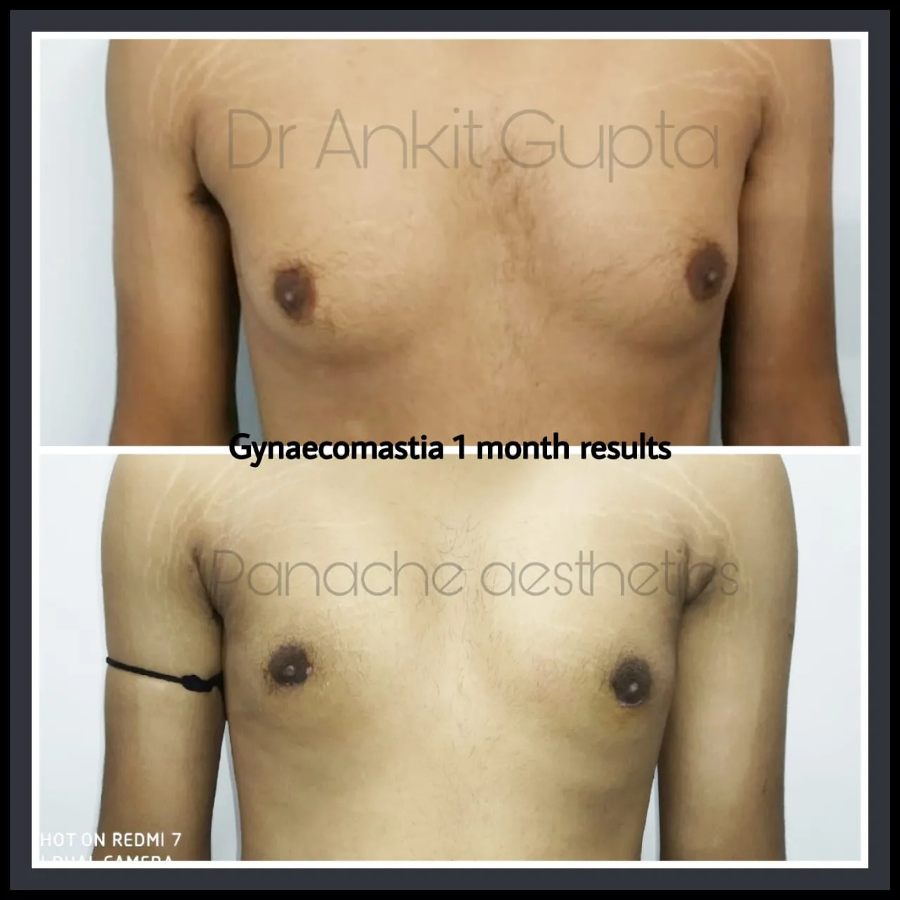 Male breast reduction before and after result — gland excision — Delhi