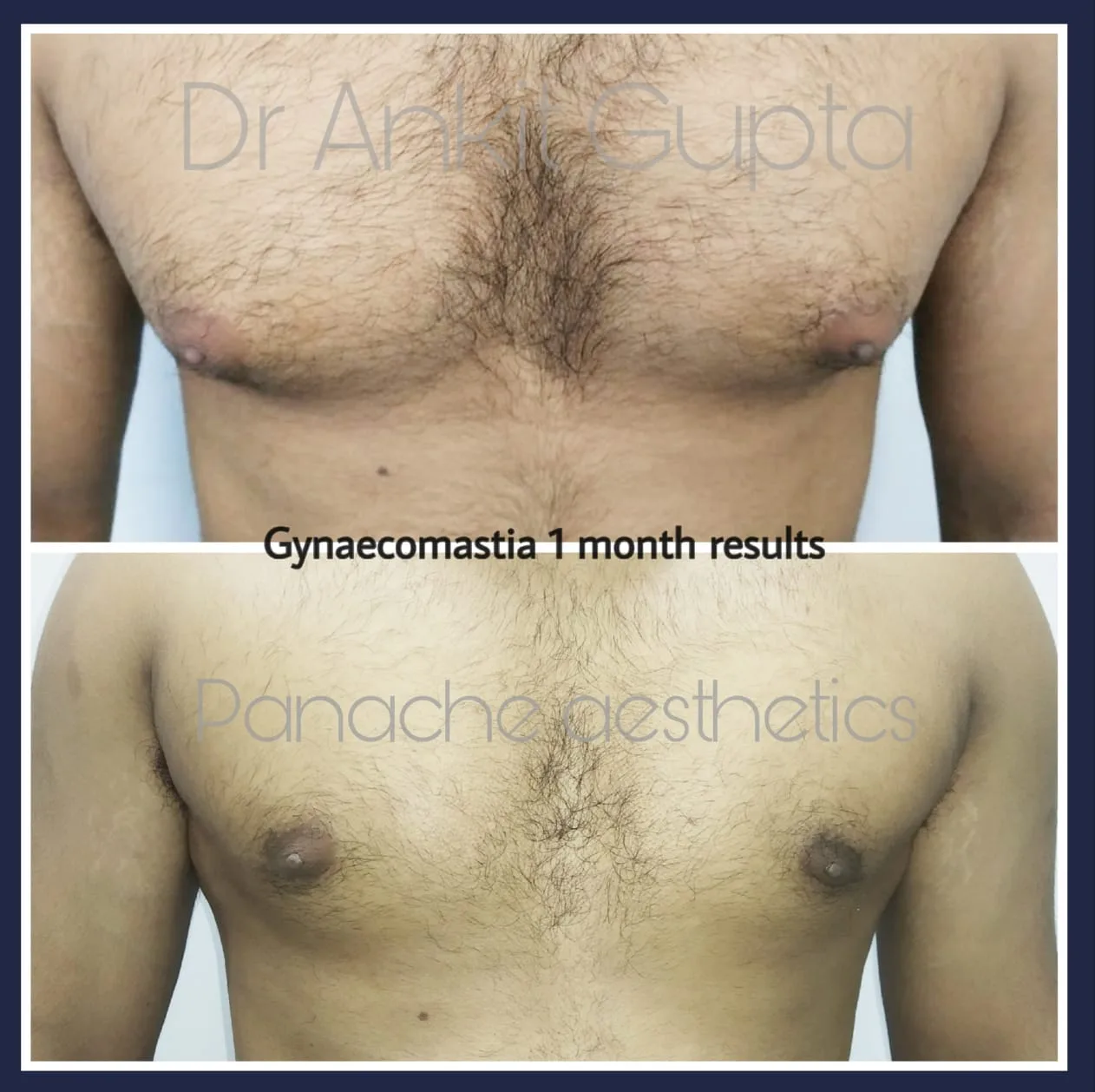 Gynecomastia before and after — flat sculpted chest — Dr. Ankit Gupta