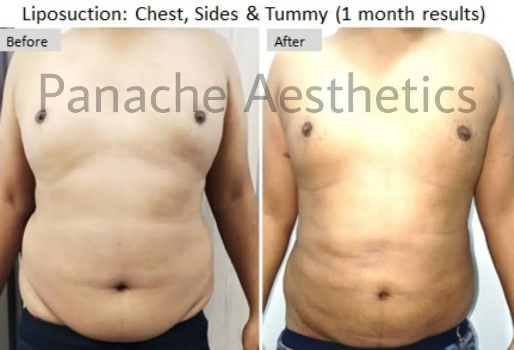 Gynecomastia surgery before and after — flat masculine chest — Dr. Ankit Gupta, Panache Aesthetics Delhi