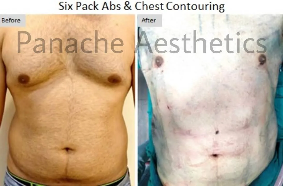 Gynecomastia gland excision and liposuction before and after result — Delhi