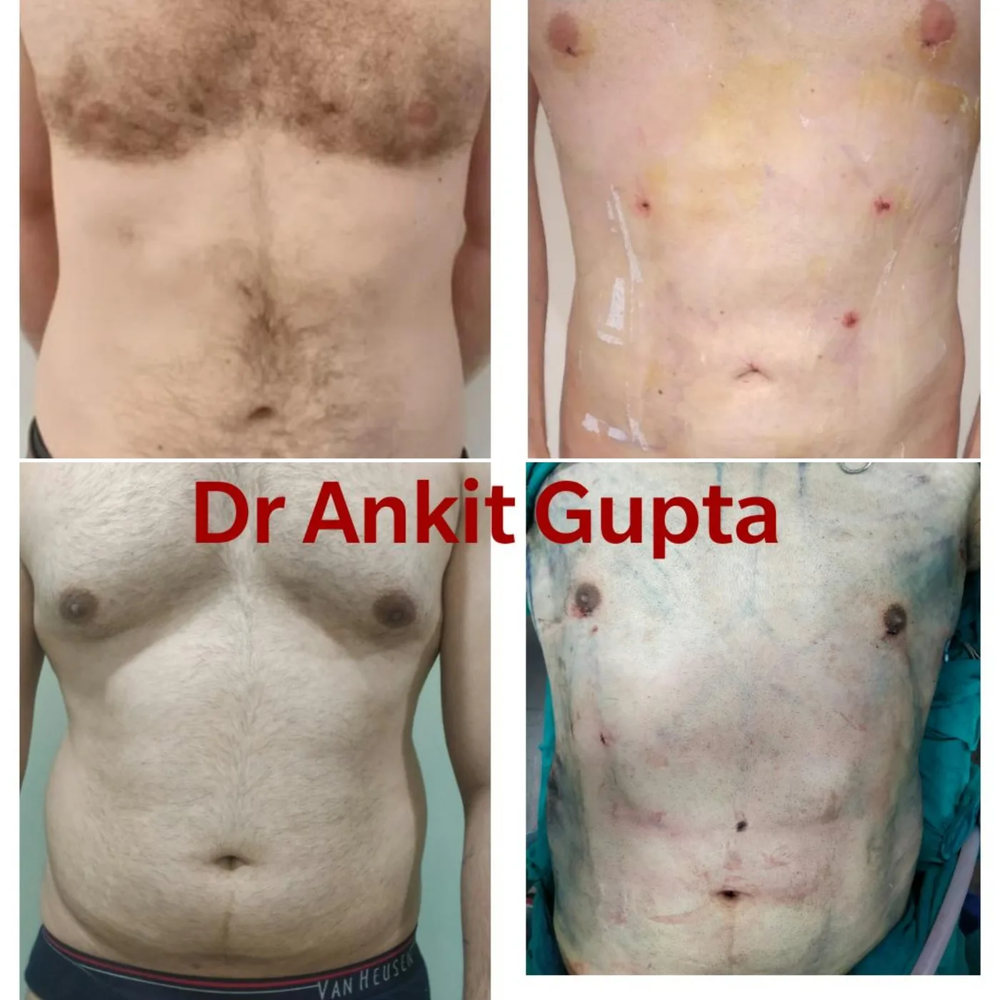 VASER gynecomastia before and after — sculpted chest — Dr. Ankit Gupta