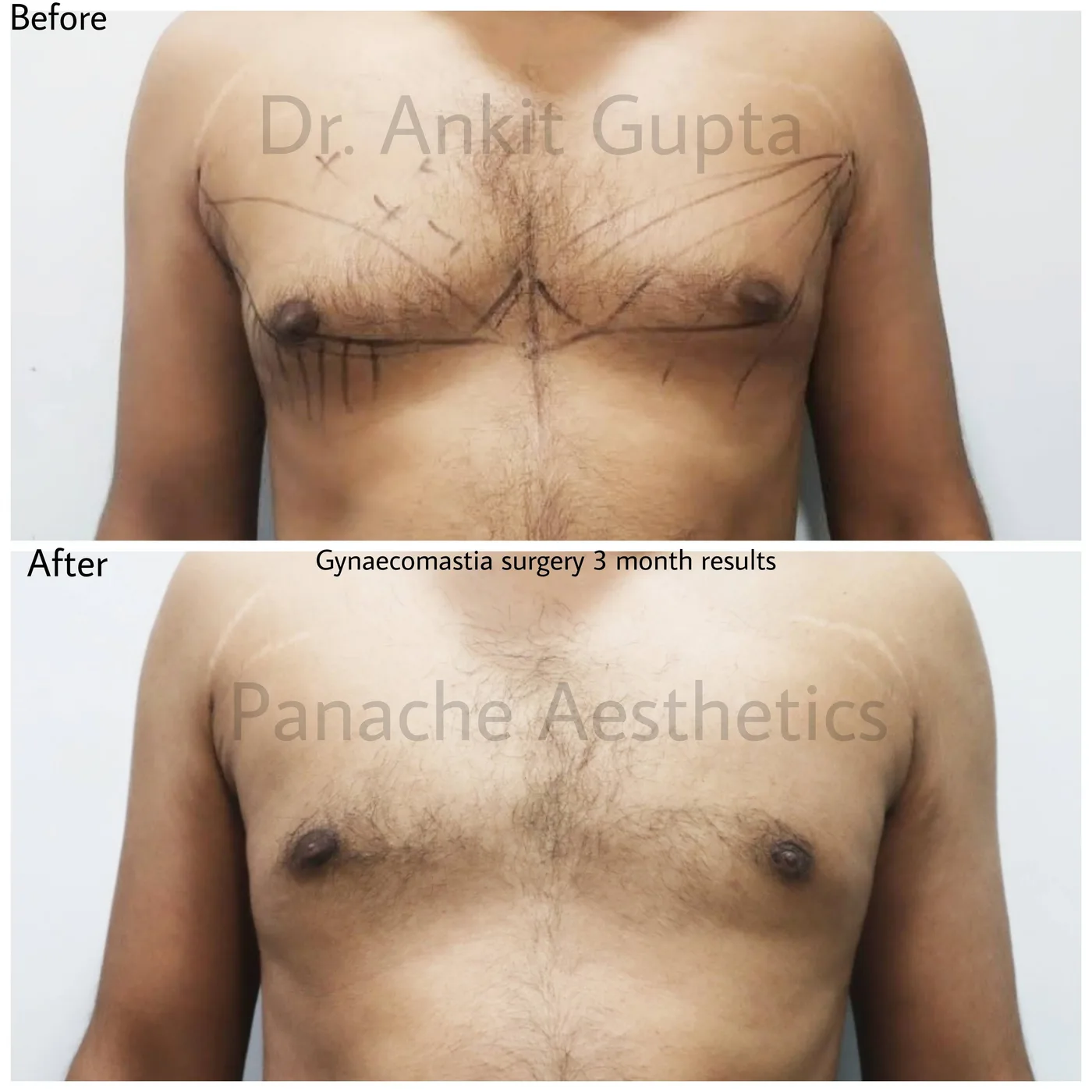 Male breast reduction before and after — gland and fat removal — Delhi