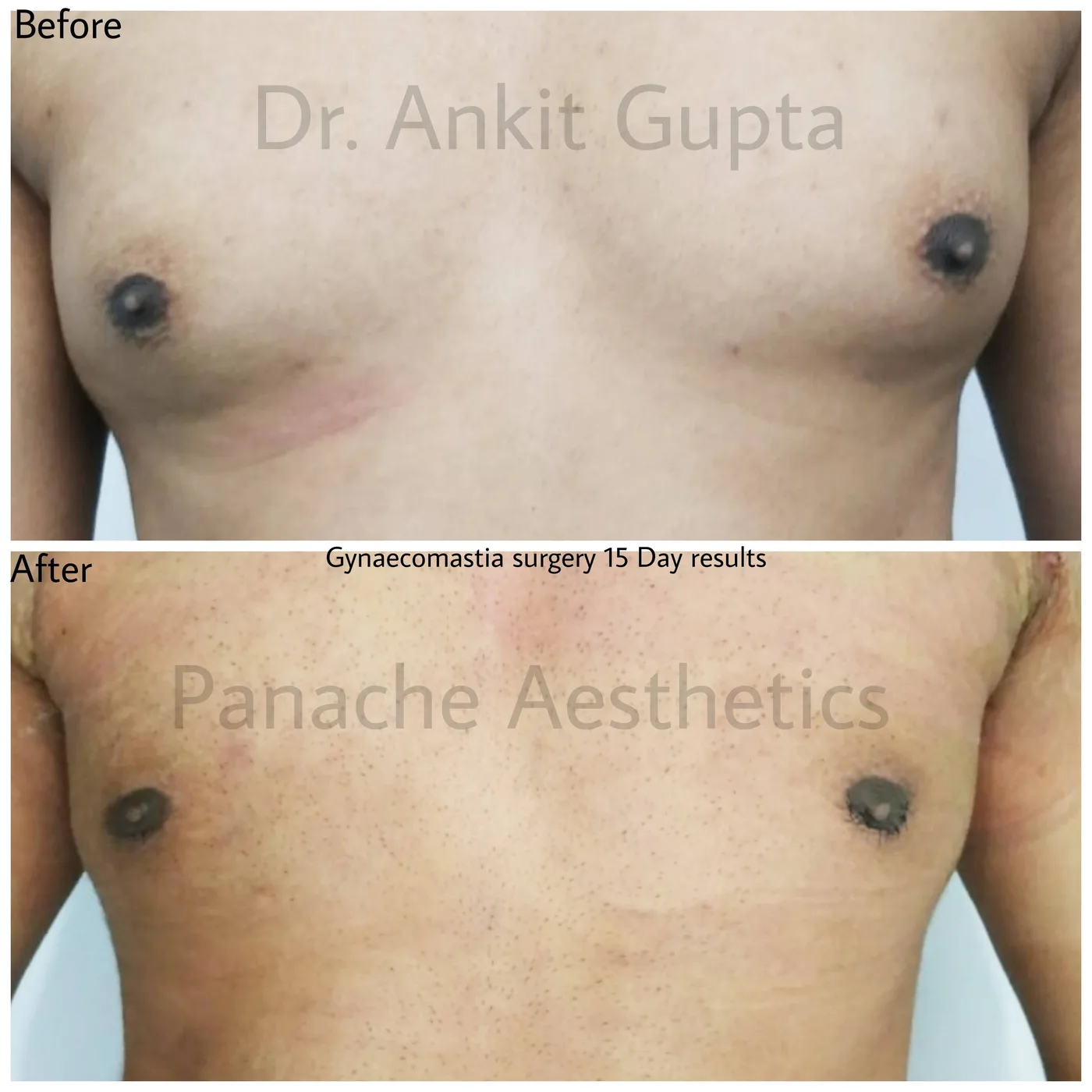 Gynecomastia before and after — sculpted masculine chest — Dr. Ankit Gupta