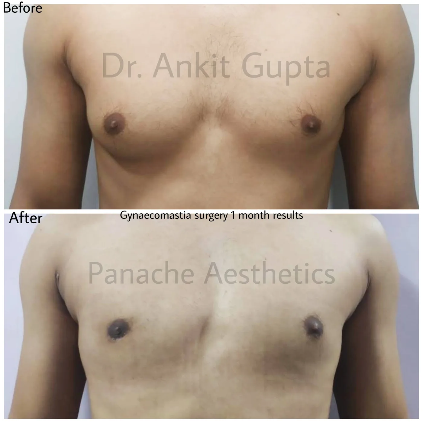 Gynecomastia surgery before and after — masculine chest like celebrities — Dr. Ankit Gupta, Panache Aesthetics Delhi