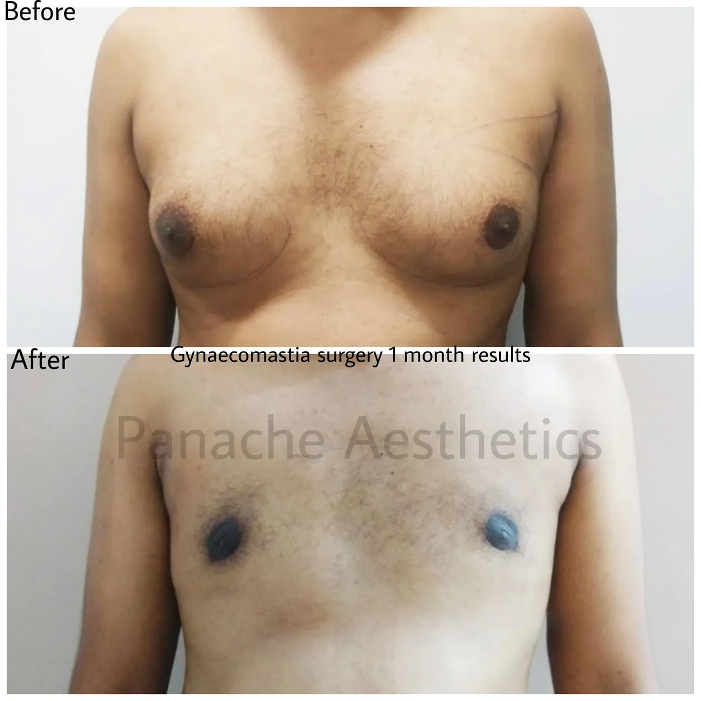 Gynecomastia gland excision before and after result — Delhi