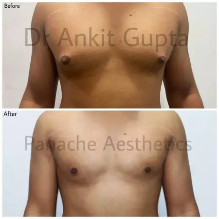 Gynecomastia correction before and after in Delhi — male breast reduction result by Dr. Ankit Gupta, Panache Aesthetics