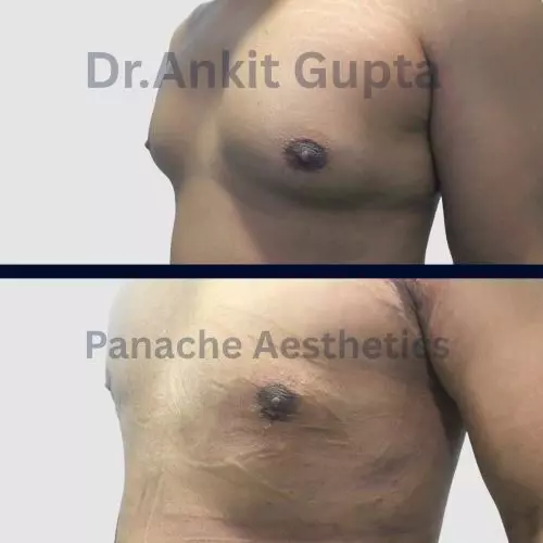 Gynecomastia surgery before and after in Delhi — flat, masculine chest result, Panache Aesthetics