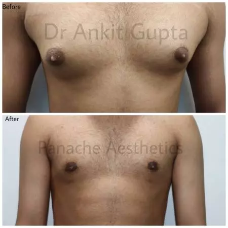 Gland-removal gynecomastia surgery before and after in Delhi — glandular male chest tissue excised for a flat contour, Dr. Ankit Gupta