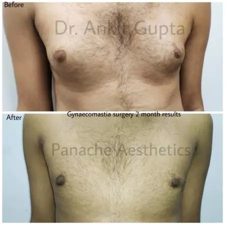 Gynecomastia surgery before and after in Delhi — male chest reduction result, flat masculine chest by Dr. Ankit Gupta, Panache Aesthetics