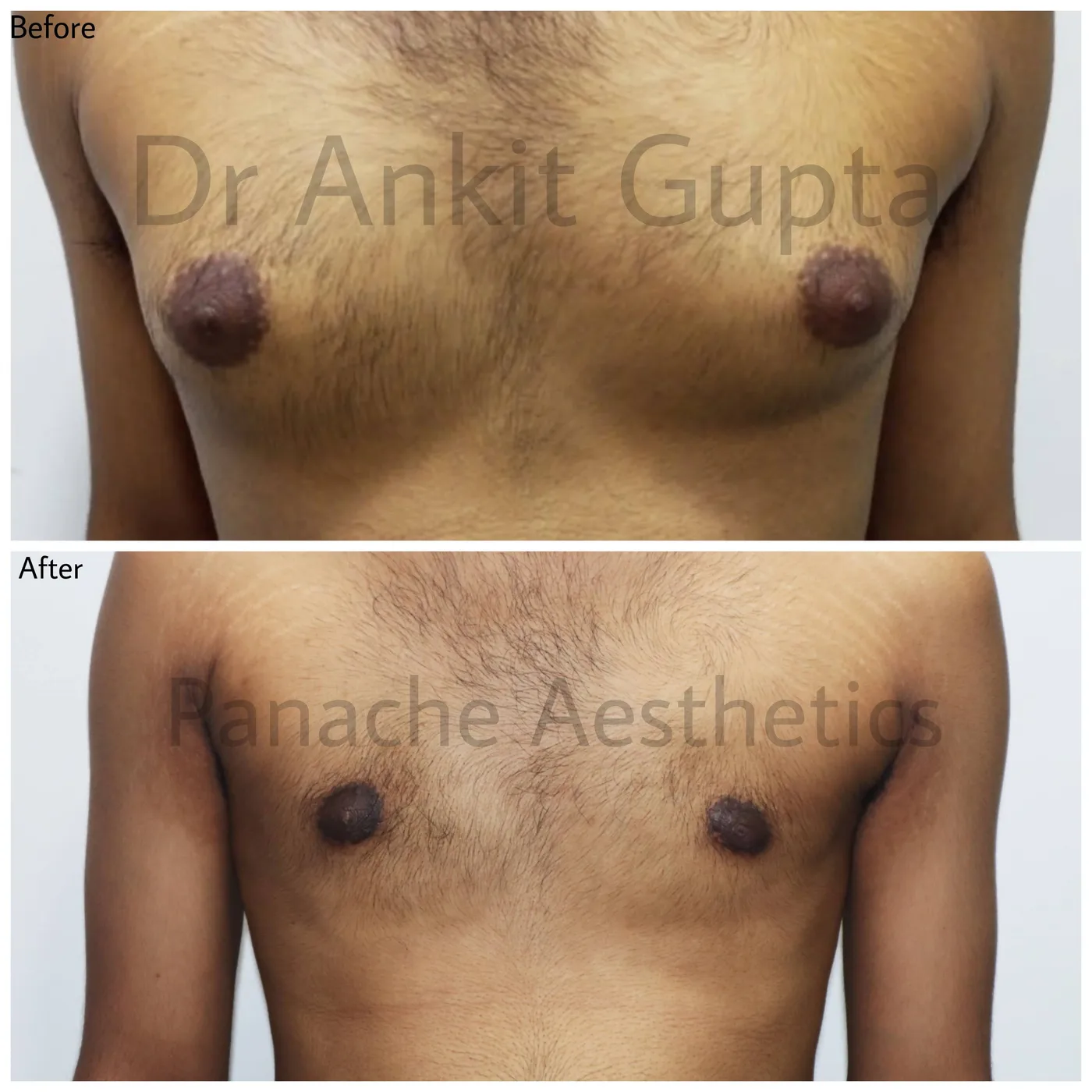 Man boobs (gynecomastia) surgery before and after in Delhi — flat male chest contour, Panache Aesthetics
