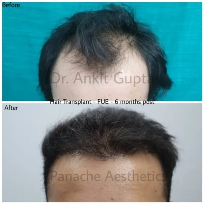 Hair transplant before and after — natural density — Dr. Ankit Gupta