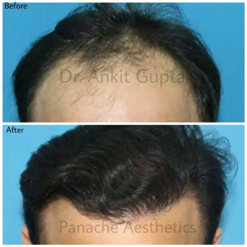 Hair transplant before and after result — improved density — Delhi
