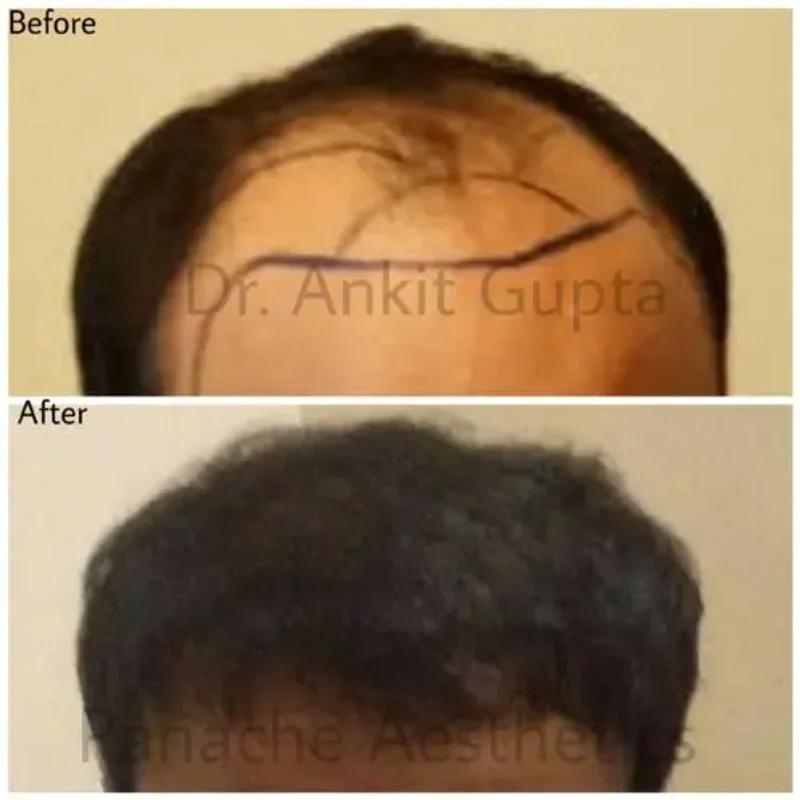 FUE hair transplant before and after — natural growth — Dr. Ankit Gupta
