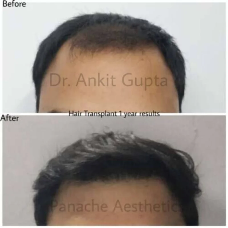 Hair transplant before and after — fuller hair — Dr. Ankit Gupta