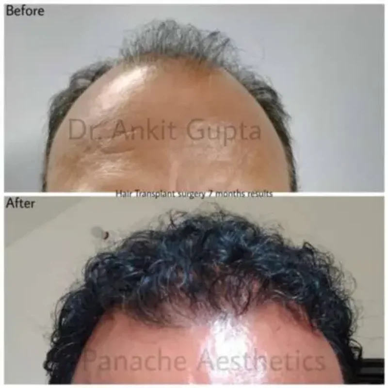 Hair transplant before and after — restored hairline — Dr. Ankit Gupta, Panache Aesthetics Delhi