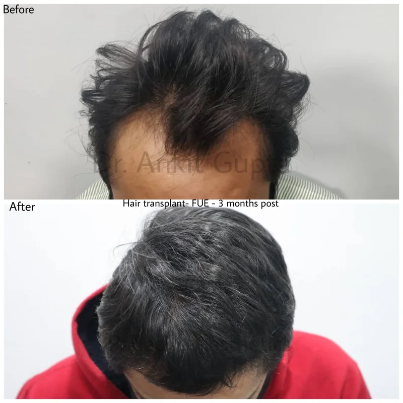 FUE hair transplant before and after result — Delhi